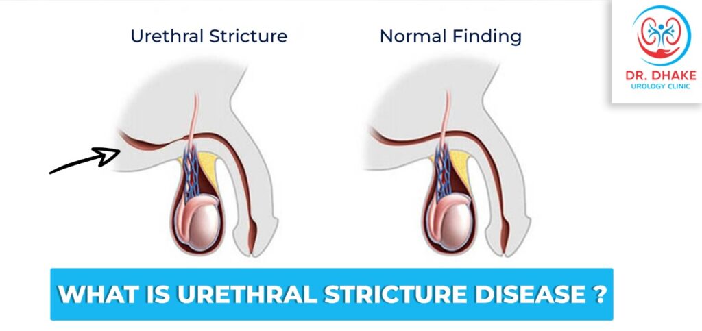 Dr. Rajesh Dhake, Urologist in Pune, Kidney Stone Specialist in Pune , Urologist in Dange Chowk , Kalewadi, Pimpri, Pune, PCMC.