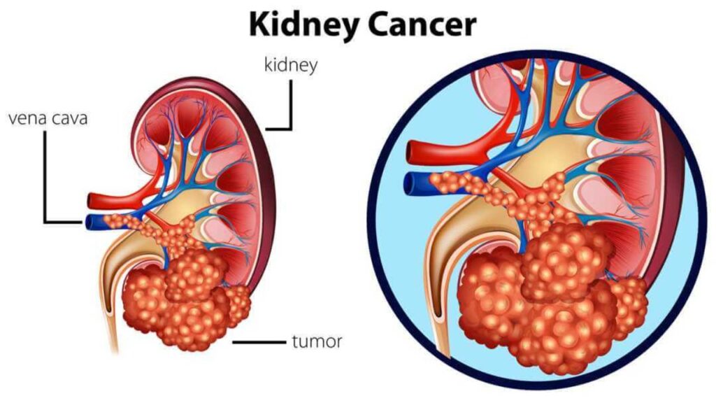 Kidney Cancer