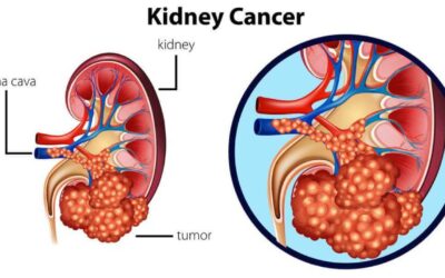 Kidney Cancer