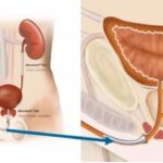 Urethral Stricture treatment by Dr. Dhake